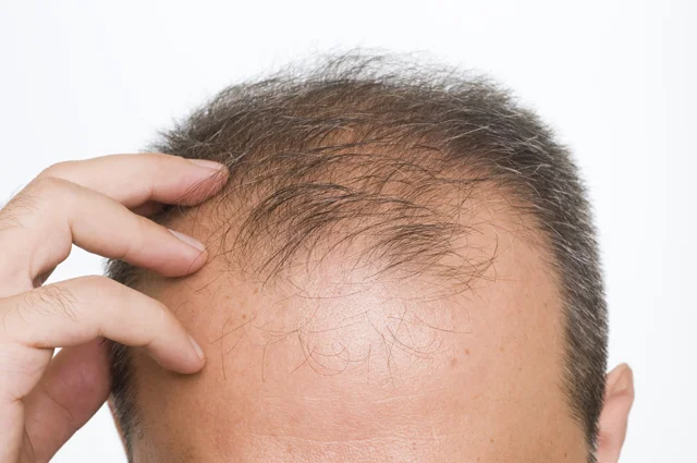 Alopecia androgenética