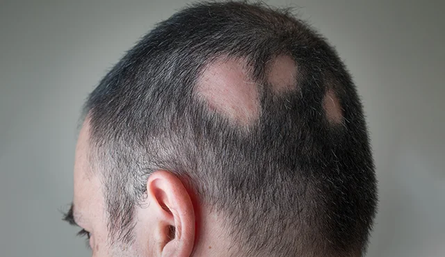 Alopecia areata