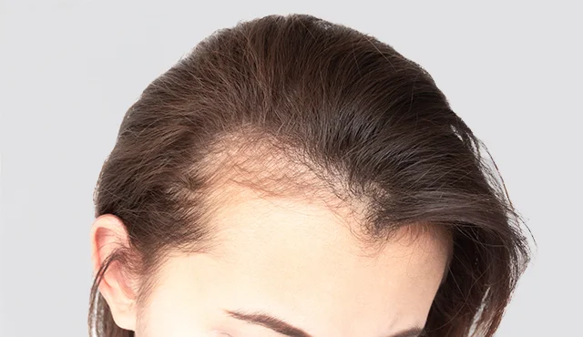 Alopecia por efluvio telogénico