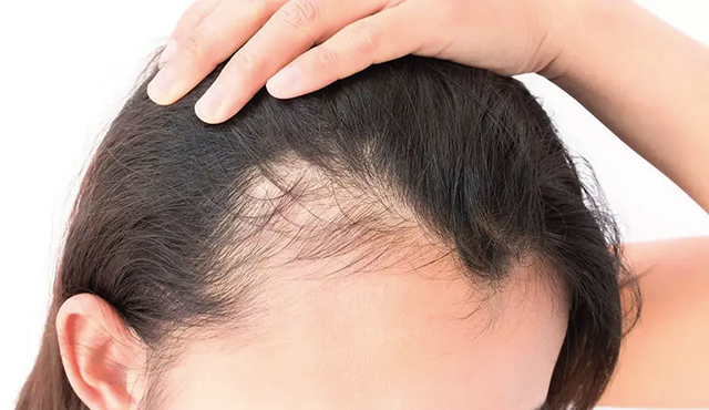 Alopecia por efluvio telogénico