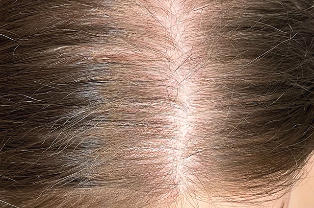 Alopecia androgenética