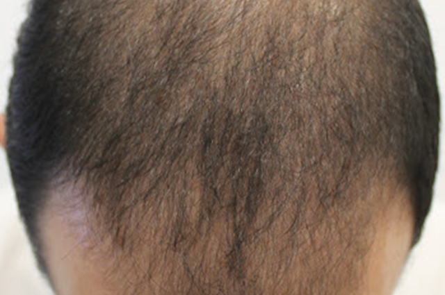 Alopecia androgenética